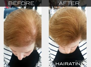 Thinning Hair