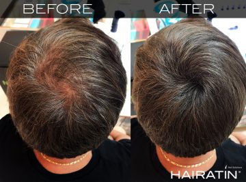 Thin Hair