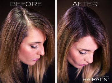 Hair Loss