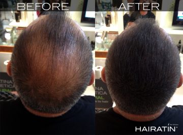 Bald Spots